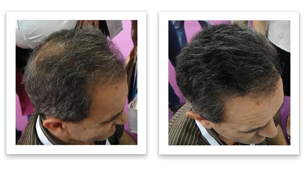 Caboki Hair Loss Concealer. All-Natural Hair Building Fiber. Make Thin Hair Look 10X Fuller Instantly. Eliminate the Appearance of Bald Spot and Thinning Hair (30G, 90-Day Supply). Salt & Pepper-Dark