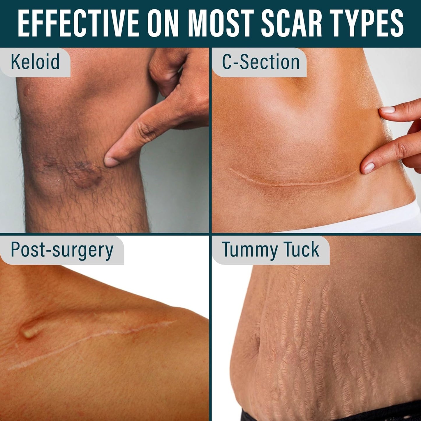 NUVADERMIS Silicone Scar Tape for Surgical Scars - 120" x 1.5" Roll - Medical Grade Scar Tape for Wrinkles, Surgical Scars, Keloid Scars, and Hypertrophic Scars - Reusable Scar Sheets Roll - 1 Pack