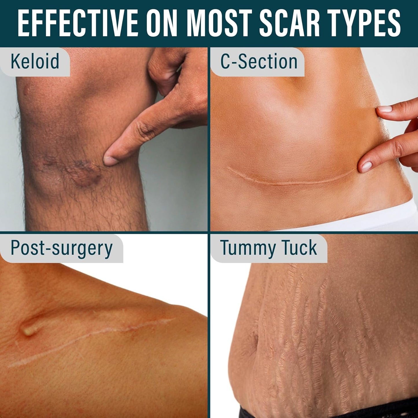 NUVADERMIS Clear Silicone Scar Tape for Surgical Scars - 120" x 1.5" Roll - Extra Long Scar Sheets for C-Section, Tummy Tuck, Keloid, and Surgical Scars - Reusable Medical Grade Silicone Scar Tape